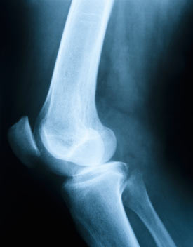 Kemik Erimesi (Osteoporoz): Kimlerde görülür, risk faktörleri, belirtileri, tanısı, tedavisi ve korunma yolları
