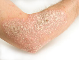 Egzema (Dermatit): Nedenleri, belirtileri, tanısı, tedavisi, alınabilecek önlemler